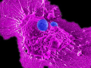 UCLA scientists develop off-the-shelf immunotherapy for ovarian cancer