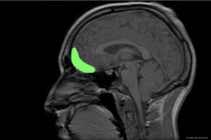 Sagittal MRI brain scan with the orbitofrontal cortex highlighted in green.