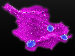 Magenta-colored cancer cell with three blue immunotherapy particles attached to its surface.
