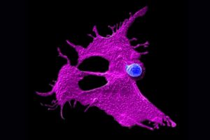 Fluorescent microscopy image of a magenta-colored cancer cell with spike-like projections and a blue nucleus against a black