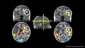 Brain scan images showing cross-sections with colored highlighted areas indicating stroke damage in Sean Maloney's brain.