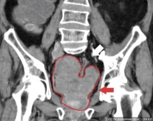 CT image of pelvis with outline and arrow indicating prostate gland