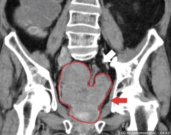 CT image of pelvis with outline and arrow indicating prostate gland